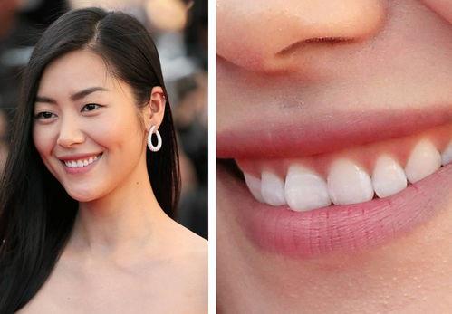 哪些明星是假牙,那些隐藏在明星笑容背后的假牙之谜